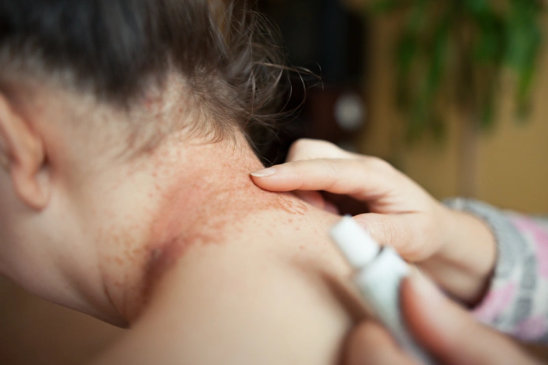 We see the back of a woman's neck, which has eczema on it. We also see hands rubbing cream on the eczema patches.