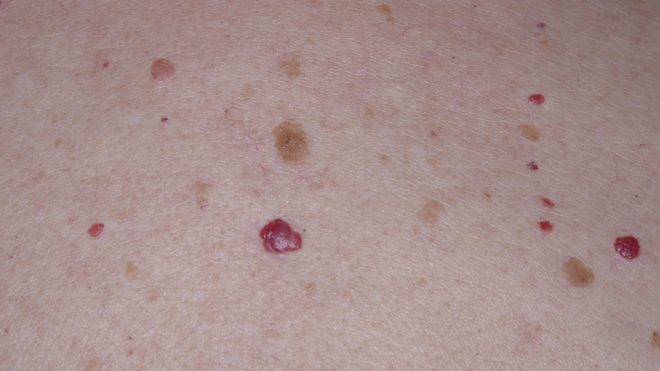 Cherry Type Rash Is Eczema Autoimmune? | Dr Thomas Addresses Your Concerns