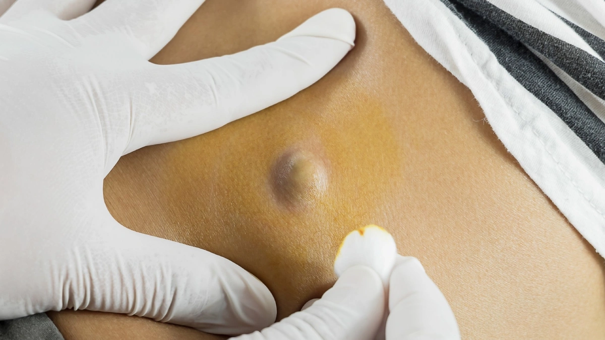 Infected sebaceous cyst: signs & treatment | Thomas Clinic